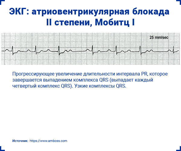 ЭКГ атриовентрикулярная блокада II степени Мобитц I